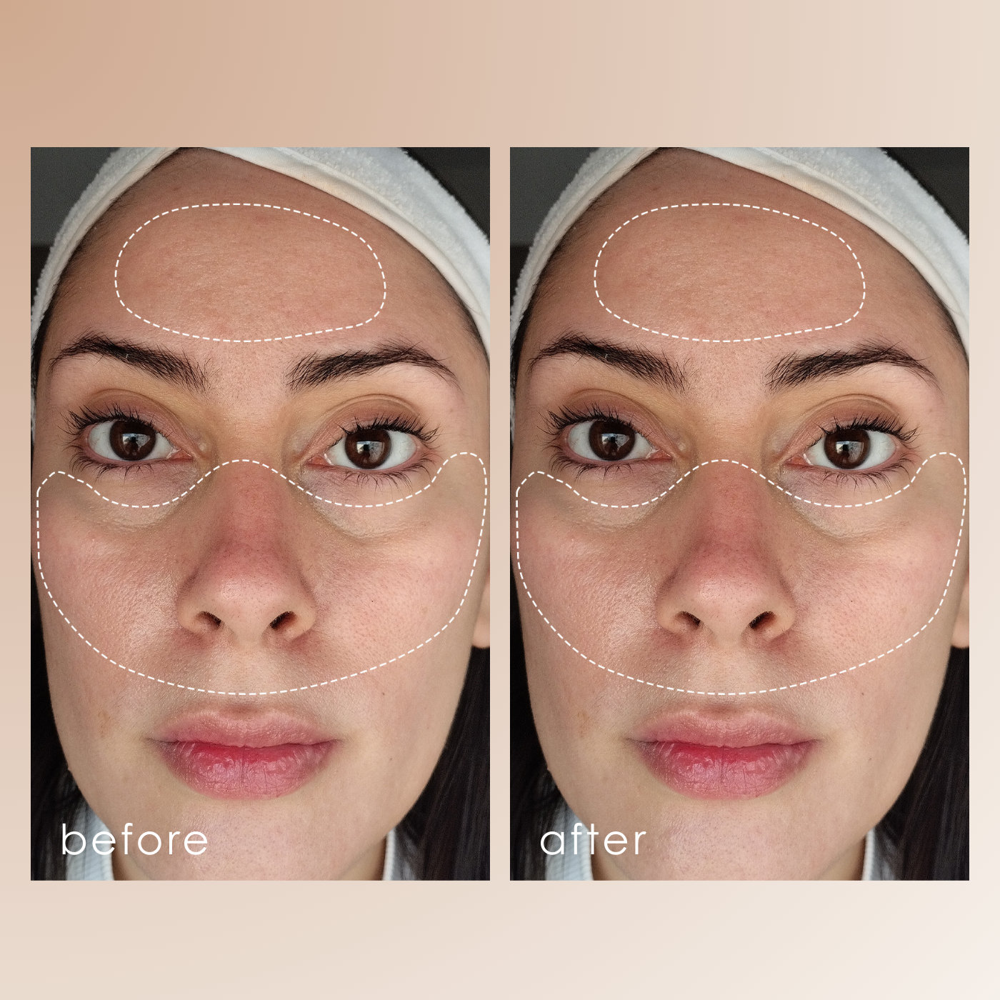 Lumamask Pro | LED Light Therapy Face Mask